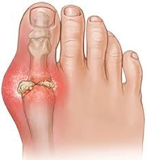 Gout is formed by a substance called uric acid in the blood. The excess level of uric acid forms crystals.