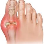 gout picture