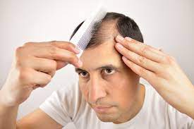 How to get rid of hair loss. Hair fall is a natural process with the age, and can be cured with natural remedies.