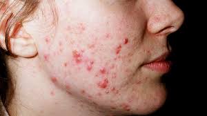 How to get rid of pimple ? How to control pimples formation by using some useful tips? Some helpful ideas to control the formation of pimples are covered in this article.