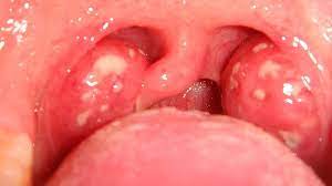 The throat is swollen and the tonsils are red.There is a chance that tonsils have a sore throat. Home remedies can help.