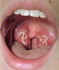 The tonsils or throat appear red and swollen. Tonsils may have pus or white areas sore throat because of bacterial infection. Home remedies may help temporally relief.