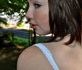 Freckles can appear on any skin exposed to the sun, such as the arms, shoulders, chest, back, or legs.