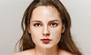 Various laser treatments, such as intense pulsed light (IPL) and fractional laser therapy, can target and break down the melanin in freckles.